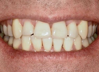 В течение 6-ти месяцев пациенту рекомендовали для удержания результата пластиковый ретейнер на верхнюю и нижнюю челюсти.