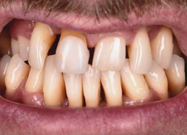 The patient complained of tooth mobility and gaps between teeth, and had been suffering from periodontal disease for over 5 years.