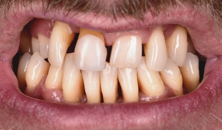 Comprehensive treatment for severe periodontitis