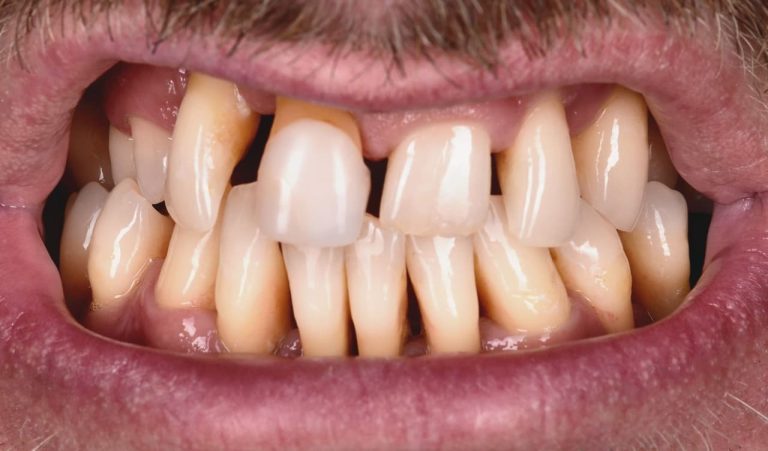 Пациент обратился с жалобами на подвижность зубов, наличие промежутков между зубами, также он отметил, что страдает пародонтитом более 5 лет.