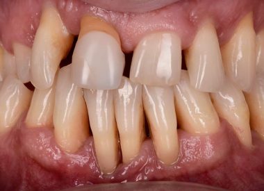 We performed periodontal disease treatment, extracted 11, 12, and 22 teeth, and installed Nobel Parallel implants at the same visit. Temporary crowns were attached to the implants a few days later.