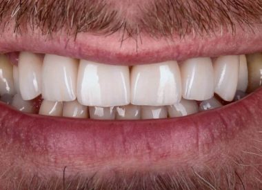 Our specialists restored the patient with ceramic crowns six months later.