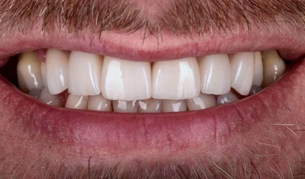 Comprehensive treatment for severe periodontitis