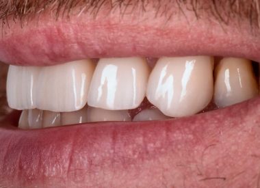 На цьому етапі ми отримали стабільний результат лікування та гарну естетику фронтальних зубів верхньої щелепи.