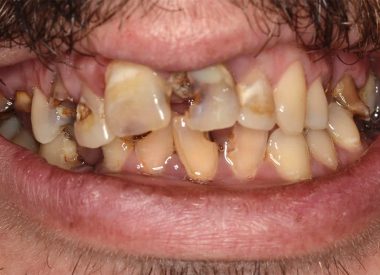Пацієнт звернувся зі скаргами на велику кількість зруйнованих зубів внаслідок карієсу. Фото до початку лікування.