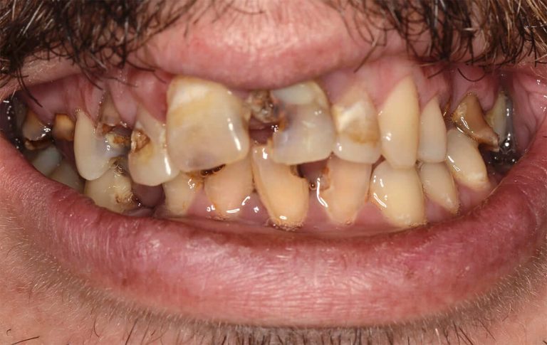 The patient sought treatment of teeth damaged by a substantial number of cavities. Photo prior to treatment.