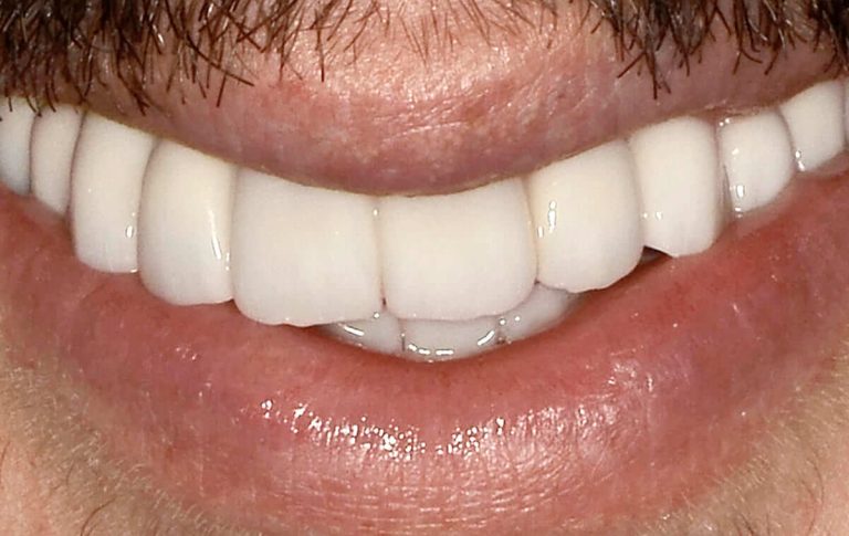 Treatment of a patient with multiple complicated cavities using zirconium crowns