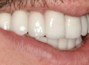 Вид полости рта после протезирования.
