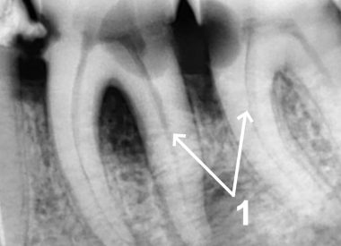 Пациент обратился с жалобами нарастающей ноющей боли в зубах нижней челюсти (36,37 зз.), усиливающейся после холодного, застревание пищи между зубами. 1 – на прицельном рентгенологическом снимке определяется кариозная полость на двух зубах. Своевременное лечение кариеса не проведено, что послужило инфицированию пульпы в корневых каналах – абсолютным показанием к эндодонтическому лечению. Под местным обезболиванием выполнено лечение...