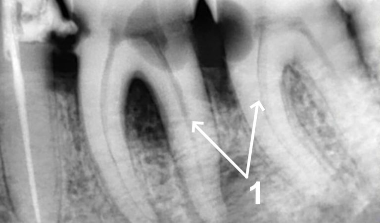 Пацієнт звернувся зі скаргами наростаючого ниючого болю в зубах нижньої щелепи (36,37 зз.), що посилюється після холодного, застрягання їжі між зубами. 1 – на прицільному рентгенологічному знімку визначається каріозна порожнина на двох зубах. Своєчасне лікування карієсу не проведено, що послугувало інфікуванню пульпи в кореневих каналах – абсолютним показанням до ендодонтичного лікування. Під місцевим знеболенням виконано...