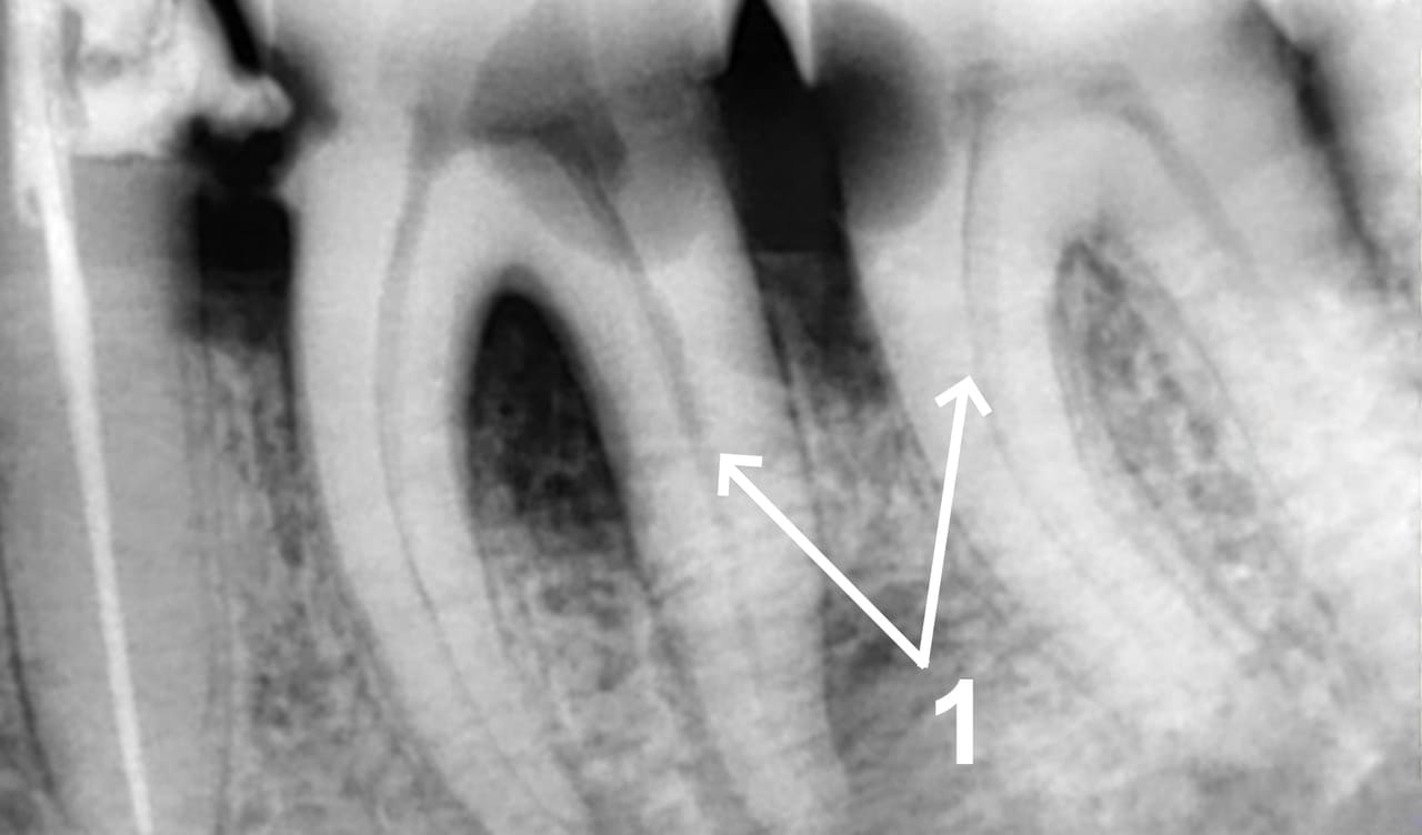 Пацієнт звернувся зі скаргами наростаючого ниючого болю в зубах нижньої щелепи (36,37 зз.), що посилюється після холодного, застрягання їжі між зубами.

1 – на прицільному рентгенологічному знімку визначається каріозна порожнина на двох зубах. Своєчасне лікування карієсу не проведено, що послугувало інфікуванню пульпи в кореневих каналах - абсолютним показанням до ендодонтичного лікування. Під місцевим знеболенням виконано лікування кореневих каналів в один візит.