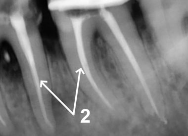 Sealing of the root canals – a guarantee for a positive prognosis. A crown restoration with photopolymer, recommendations on home oral care with a focus on interdental spaces as prevention of such diseases. 2 – Check-up X-ray after root canal filling.