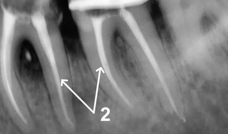 Emergency Endodontics as a Consequence of Untreated Cavities
