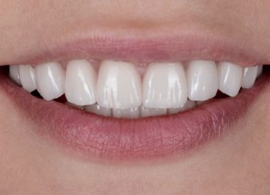 Следующим этапом было снять окончательные оттиски и передать в работу зуботехнической лаборатории. Зубные техники в течении 10 дней изготовили керамические реставрации, которые после примерки и согласования с пациентом, были фиксированы в полости рта.