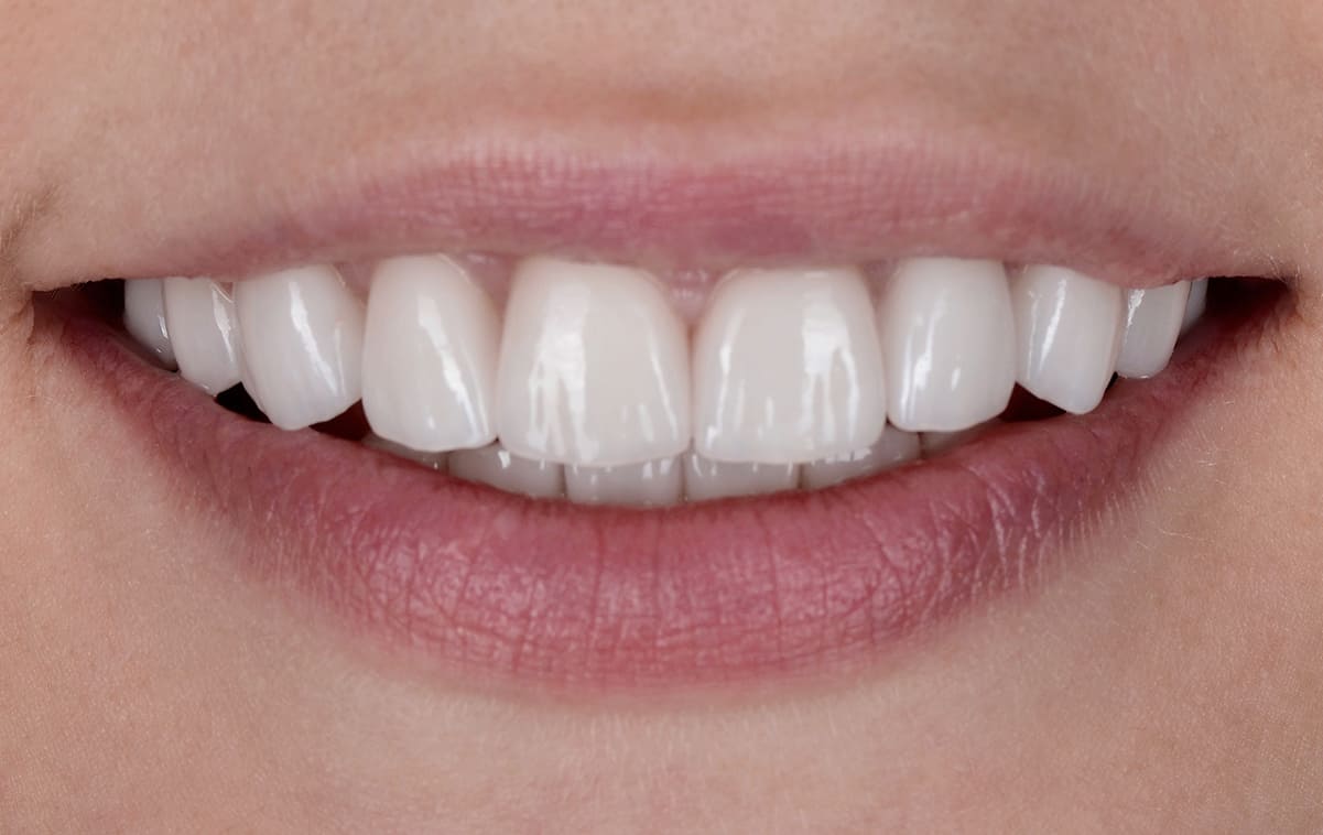 Beautiful smile with an all-ceramic restoration