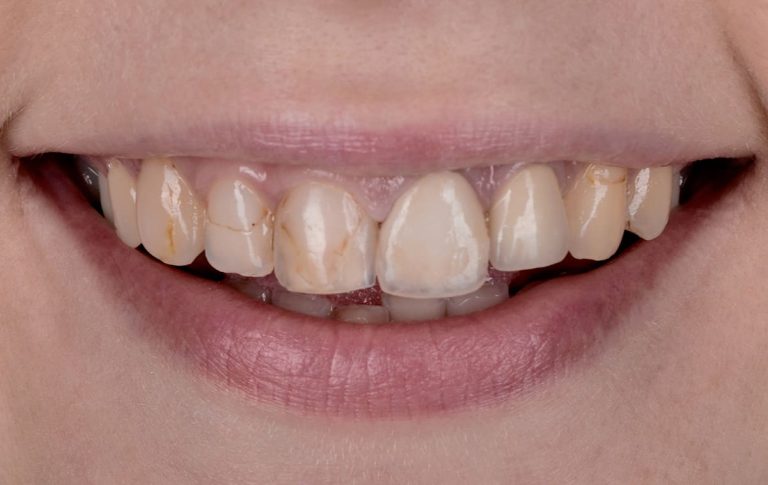 Beautiful smile with an all-ceramic restoration