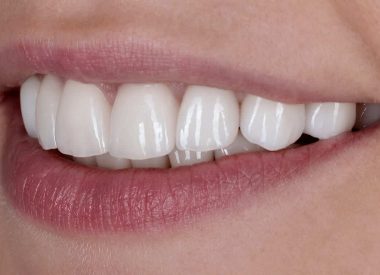 Пациентка получила красивую белоснежную улыбку и полностью удовлетворена результатом лечения зубов.