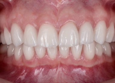 After the patient approved the treatment plan, the dentists proceeded to the hygiene treatment and therapy. Next, temporary dental crowns corresponding to the shape and morphology of the expected teeth were made.