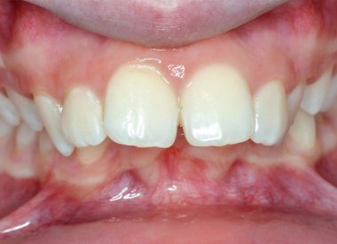 Пациентка обратилась за ортодонтической помощью в стоматологическую клинику из-за неэстетической пропорции лица.