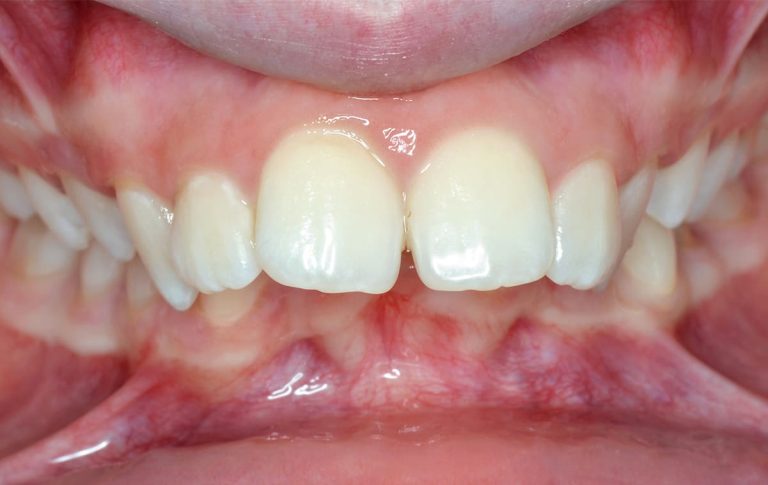 Пацієнтка звернулась по ортодонтичну допомогу в стоматологічну клініку через неестетичні пропорції обличчя.