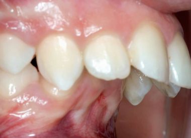 Наш ортодонт встановив наступний діагноз: глибокий дистальний травмувальний прикус, звуження зубних дуг; скупченість зубів верхньої та нижньої щелеп; мілкий пристінок рота, недорозвинення нижньої щелепи.