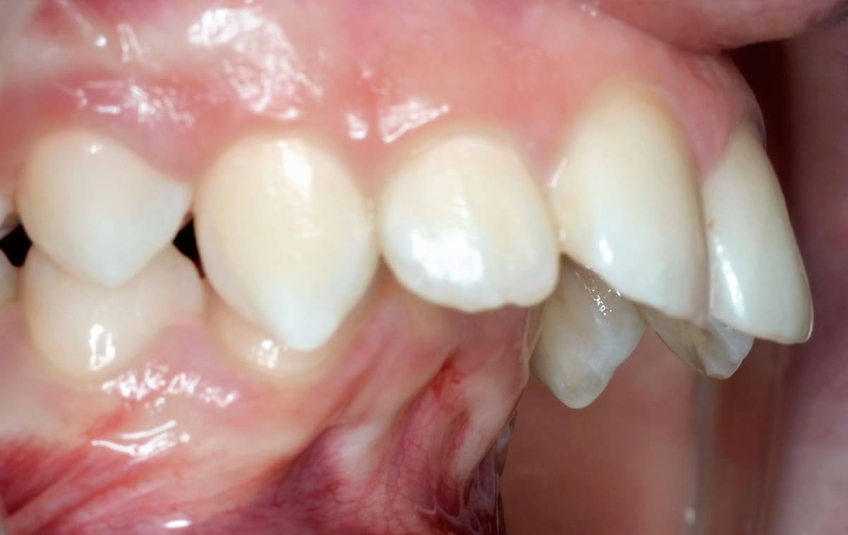 Our orthodontist diagnosed a traumatic deep distal bite, narrowing of the dental arches. Crowding of the teeth of the upper and lower jaws. The shallow vestibule of the mouth, and underdeveloped lower jaw.