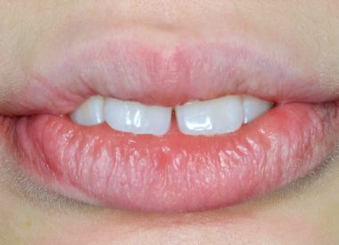Так як пацієнтка підліткового віку, була можливість лікувати патологію без видалення зубів, шляхом стимулювання росту нижньої щелепи і розширення бокових ділянок зубних дуг, поглиблення пристінку рота.
