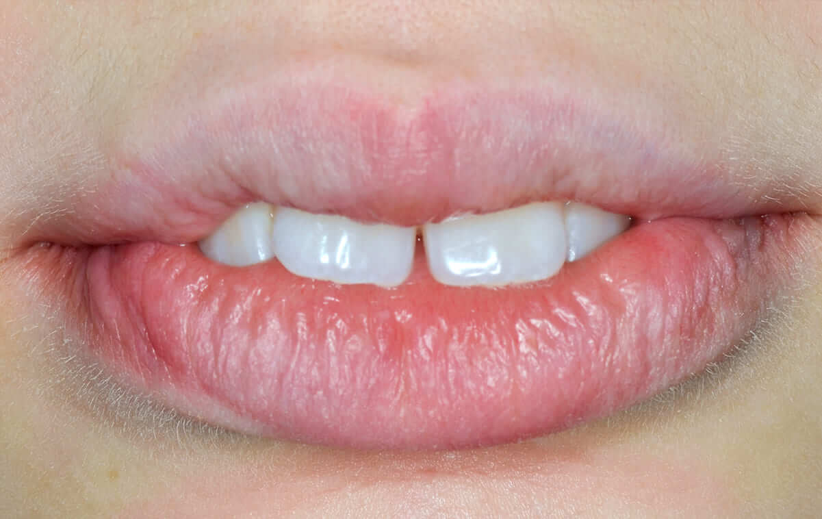 Так как пациентка подросткового возраста, была возможность лечить патологию  без удаления зубов, путем стимулирования роста нижней челюсти и расширения боковых участков зубных дуг, углубления преддверия рта.