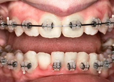 Після чотирьох місяців лікування провели хірургічний етап – поглиблення пристінку рота. Корекція брекет-системи проводилась кожні 6-8 тижнів впродовж двох років, так як зіштовхнулись зі складною скелетною патологією.