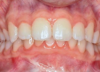 The patient had concomitant chronic conditions that complicated the orthodontic treatment process.