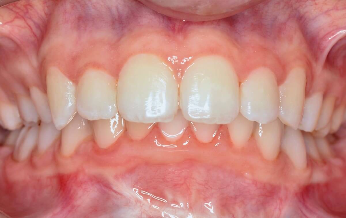 The patient had concomitant chronic conditions that complicated the orthodontic treatment process.
