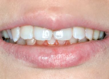 By the end of orthodontic treatment, the plastic retainers to fix and maintain the result of the treatment were manufactured.