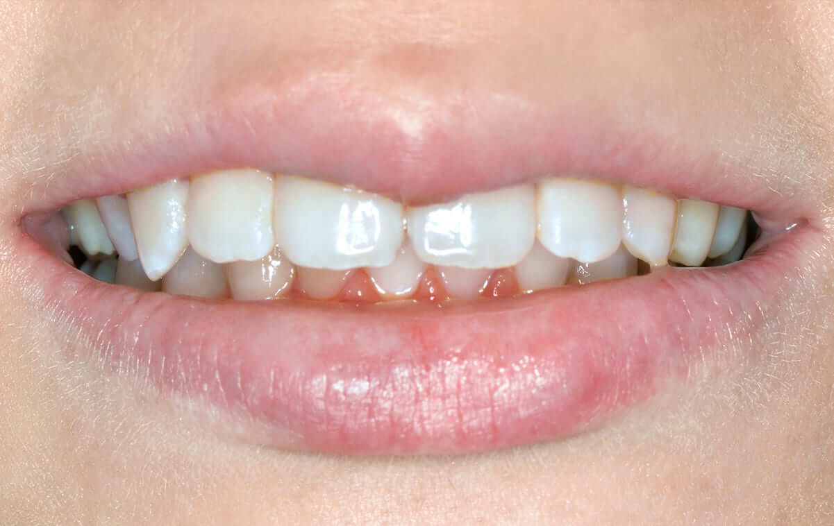 После окончания ортодонтического лечения были изготовлены пластиковые ретейнеры, которые рекомендуется носить для закрепления и удержания результата лечения.