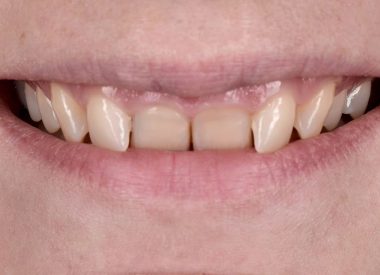 The patient decided to improve the aesthetic appearance of the maxillary anterior teeth.