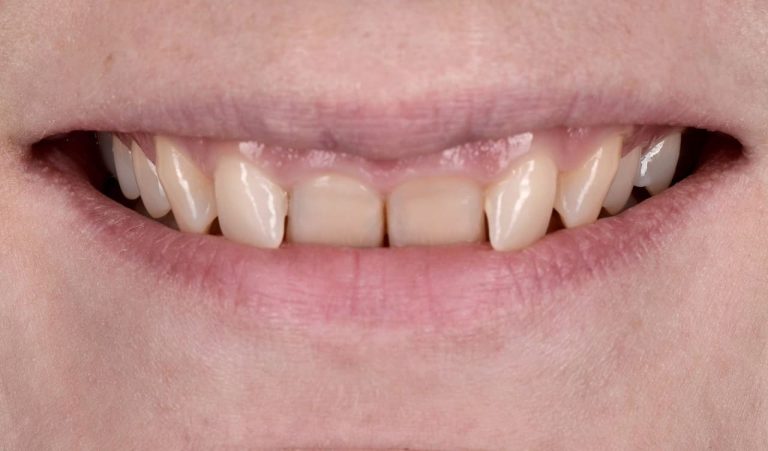 The patient decided to improve the aesthetic appearance of the maxillary anterior teeth.