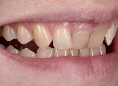 She refused the recommended orthodontic treatment involving the use of braces.