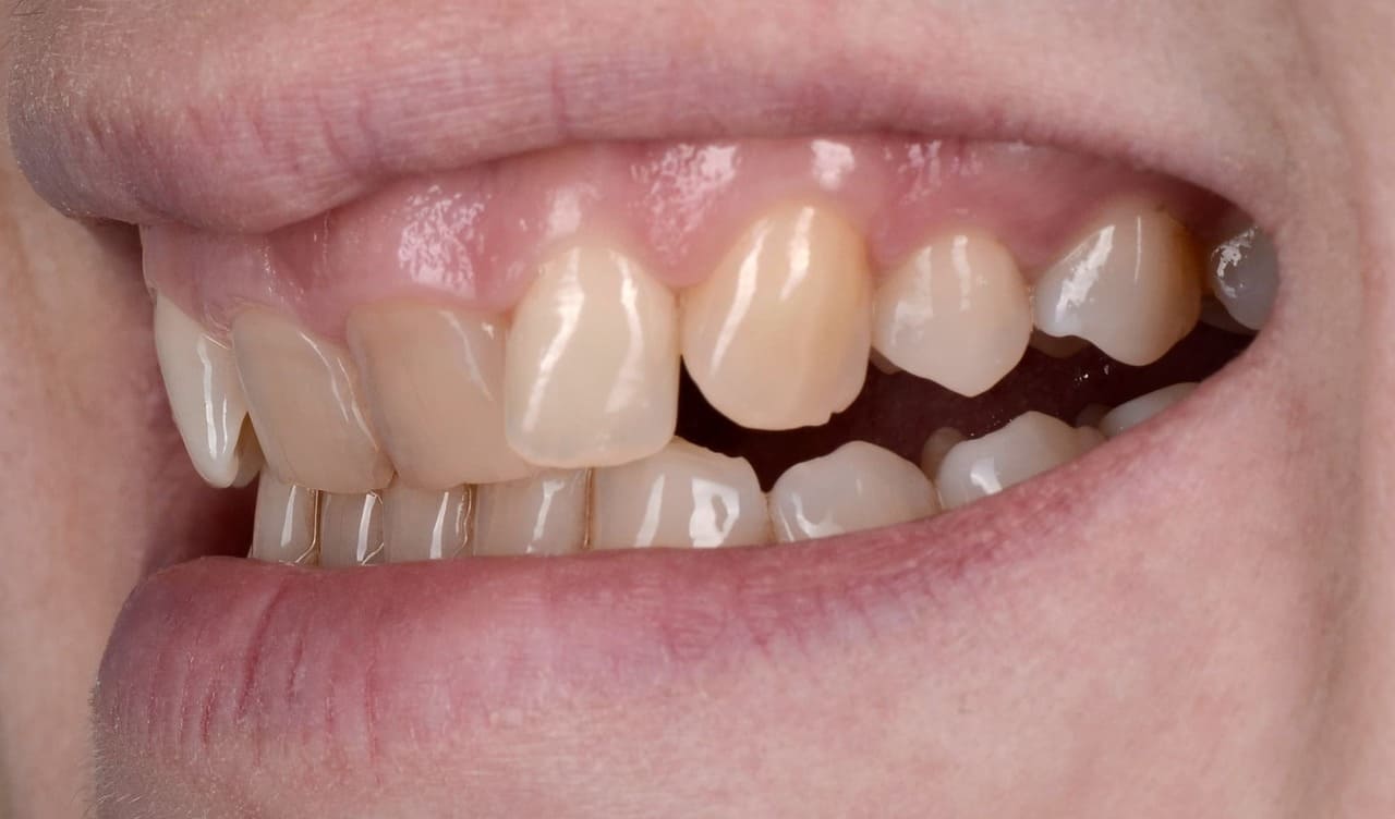 We agreed on an alternative treatment plan of the four upper incisors with ceramic restorations.