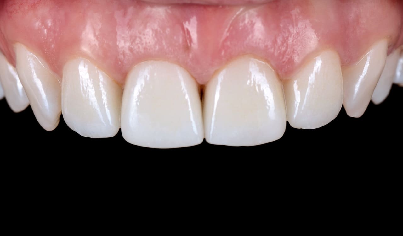Minor correction of the soft tissues in the area of the central incisors was carried out, and four incisors were ground down for ceramic veneers, and impressions were taken.