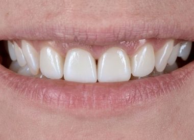Ten days later, the ceramic veneers are fixed in the oral cavity.