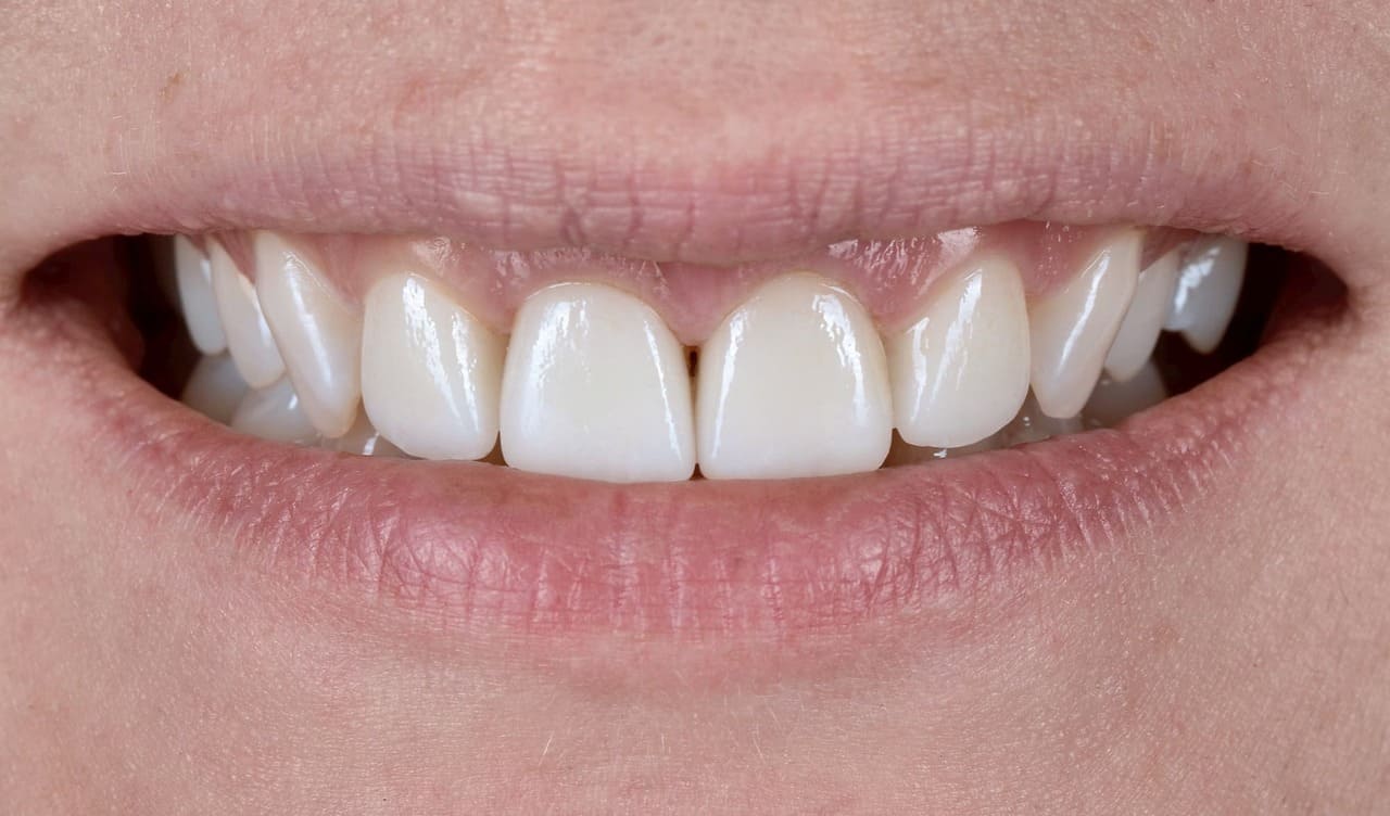 Ten days later, the ceramic veneers are fixed in the oral cavity.