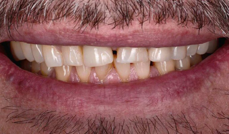 Orthodontic treatment of pathological tooth abrasion