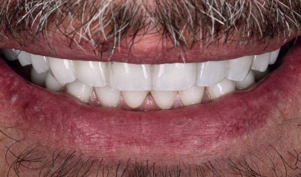 Ортопедическое лечение патологической стираемости зубов