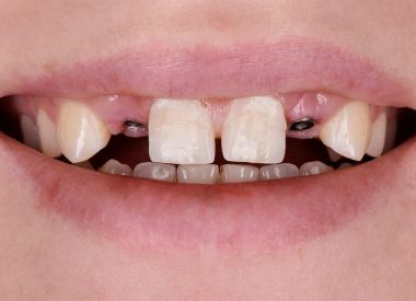 Пацієнтка після ортодонтичного лікування звернулась в стоматологічну клініку з проханням отримати незнімні конструкції на місці відсутніх других верхніх зубів.
