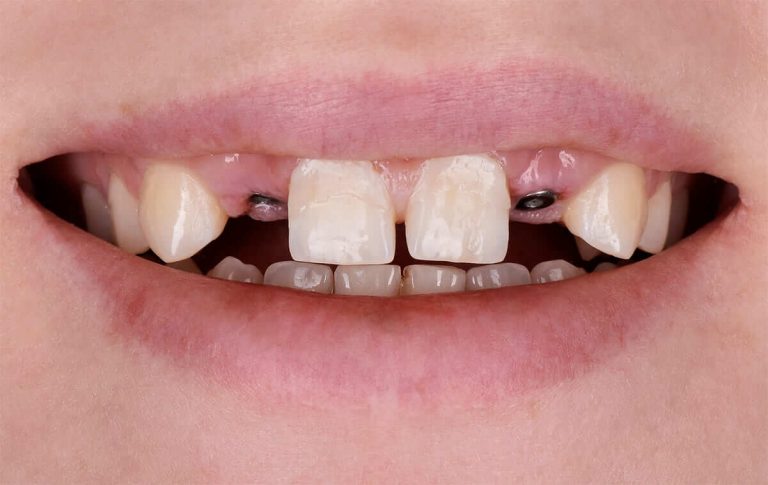 Пациентка после ортодонтического лечения зубов обратилась в стоматологическую клинику с просьбой получить несъемные конструкции на месте отсутствующих вторых верхних зубов.