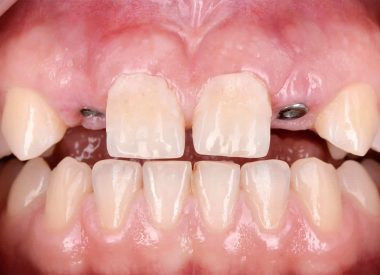 Зачатки зубів 12, 22 були відсутні. Між центральними зубами спостерігалась діастема. Пацієнтці була запропонована імплантація зубів одночасно разом з операцією по збільшенню кісткової тканини, з подальшим протезуванням