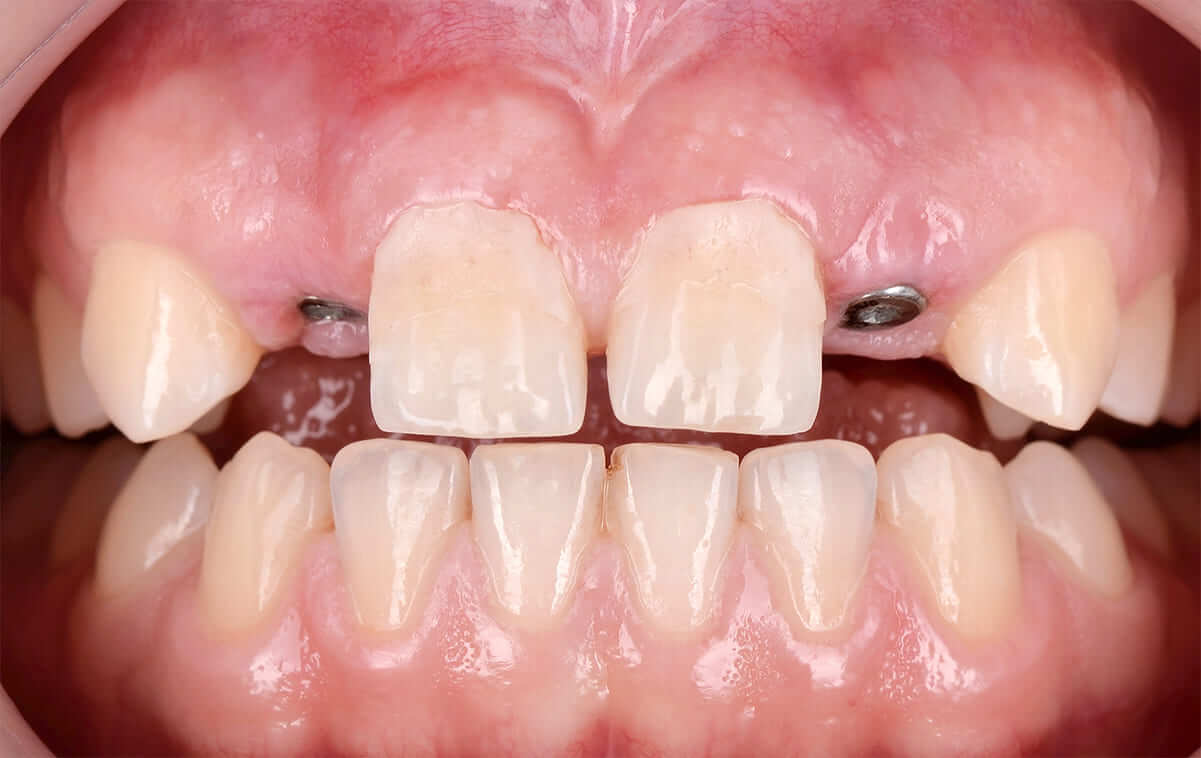 Зачатки зубів 12, 22 були відсутні. Між центральними зубами спостерігалась діастема.

Пацієнтці була запропонована імплантація зубів одночасно разом з операцією по збільшенню кісткової тканини, з подальшим протезуванням