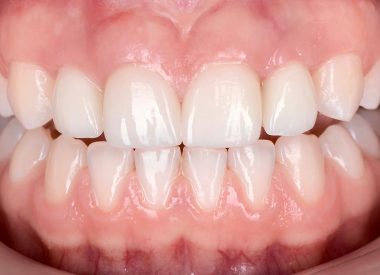 Через 4 месяца после имплантации пациентке были фиксированы формирователи десны и сняты оттиски для изготовления цельнокерамических виниров на 11 и 21 зубы и цельнокерамических коронок на индивидуальных циркониевых абатментах на 12 и 22 зубах.