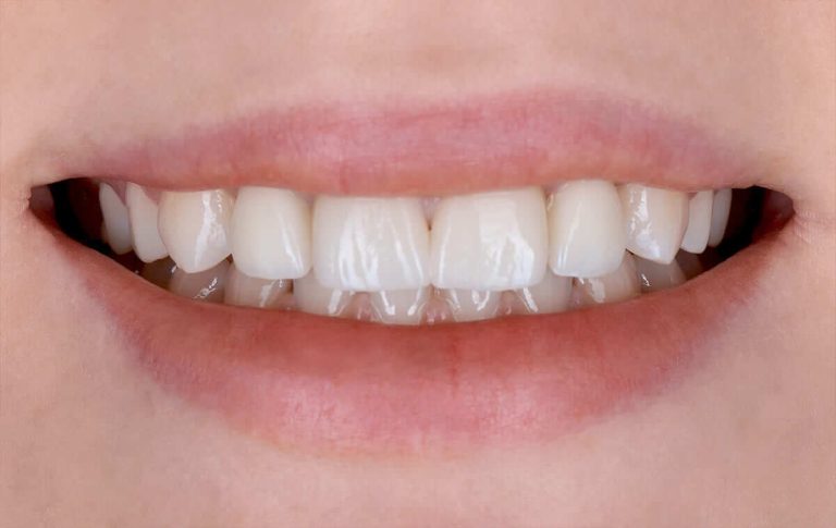 Implant rehabilitation of a patient with edentulism due to congenitally missing maxillary lateral incisors after orthodontic treatment