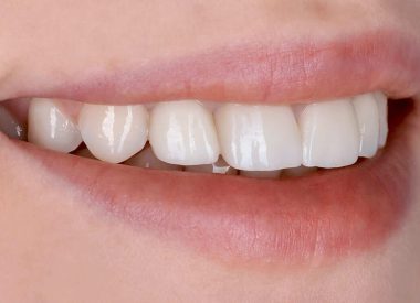 The patient was completely satisfied with her all-ceramic tooth restorations.