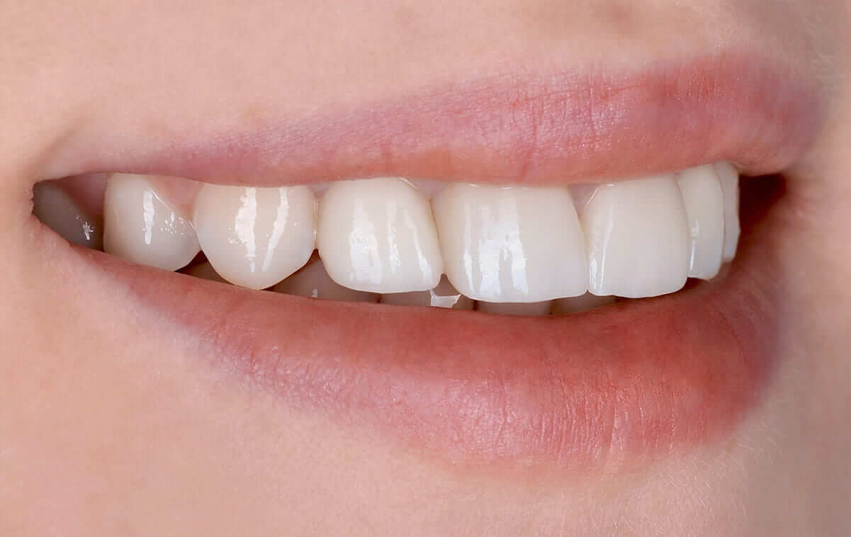 Цільнокерамічні реставрації зубів повністю влаштували пацієнтку.